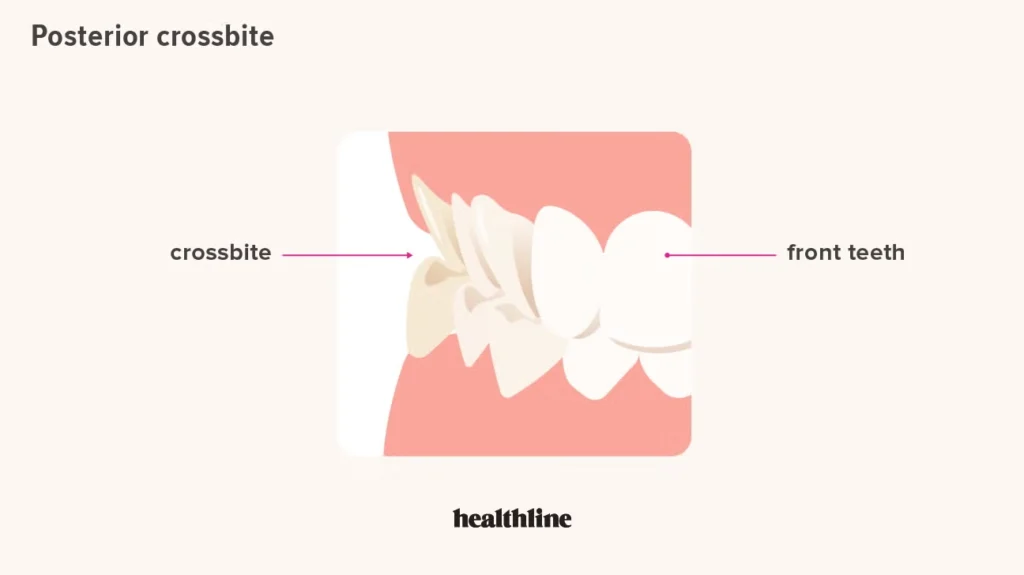 Posterior crossbite