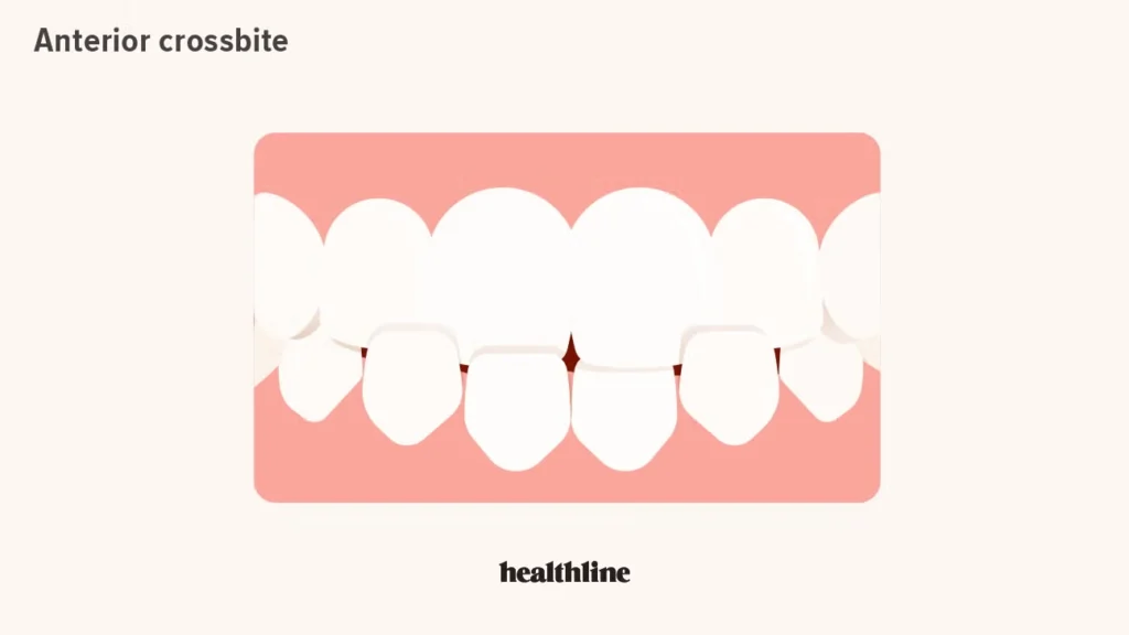 crossbite anterior
