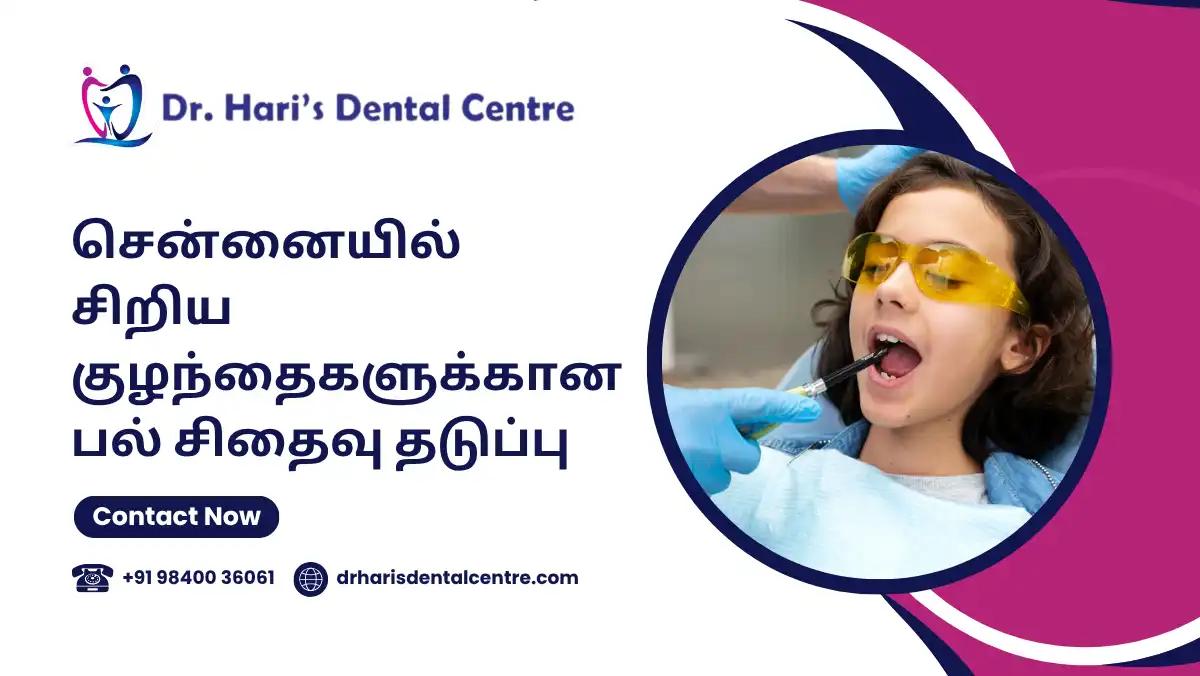 சென்னையில் சிறிய குழந்தைகளுக்கான பல் சிதைவு தடுப்பு