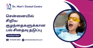 சென்னையில் சிறிய குழந்தைகளுக்கான பல் சிதைவு தடுப்பு