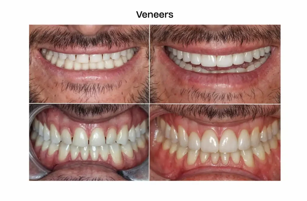 veneers