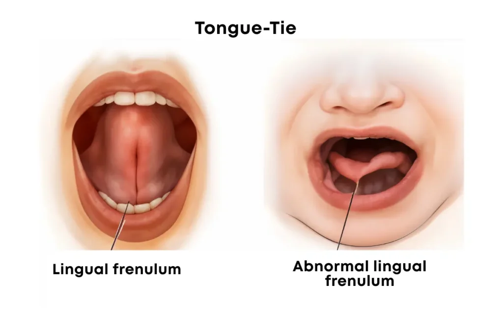 Tongue-Tie Procedure