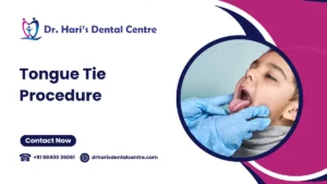Tongue-Tie Procedure 