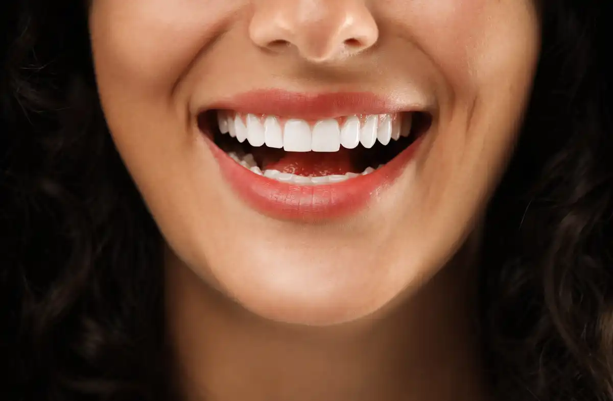 Veneers