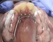 Posterior Bite