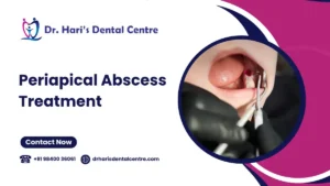 Periapical Abscess Treatment