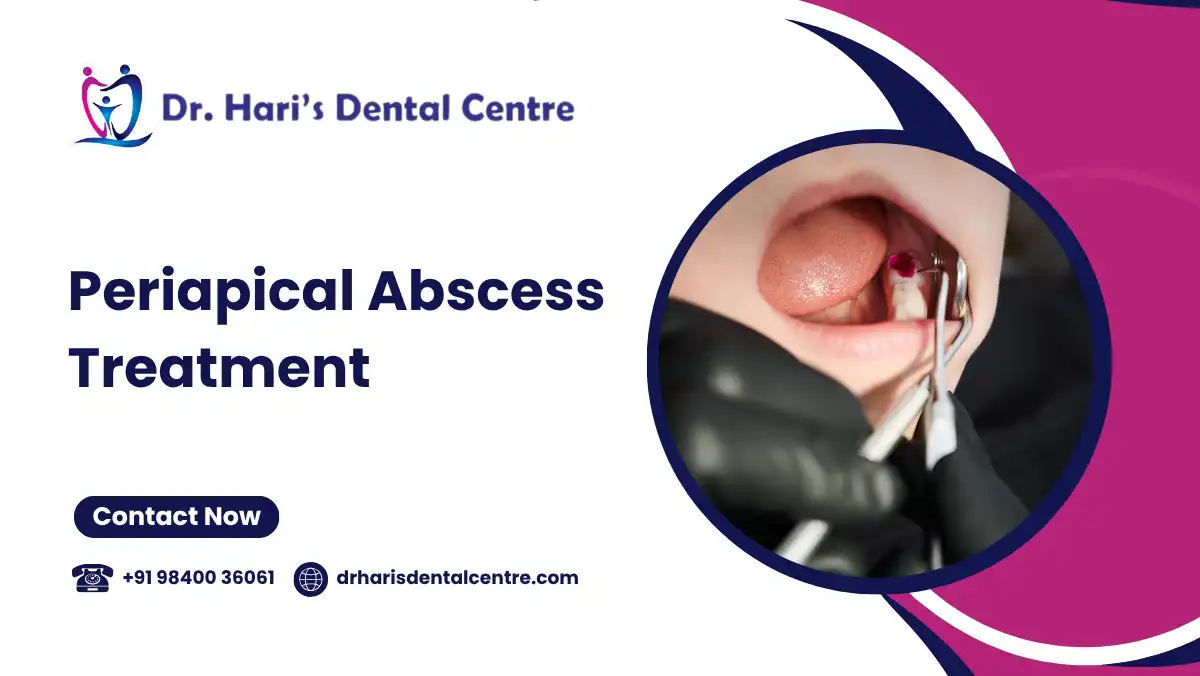 Periapical Abscess Treatment