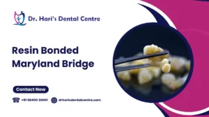Resin Bonded Maryland Bridge