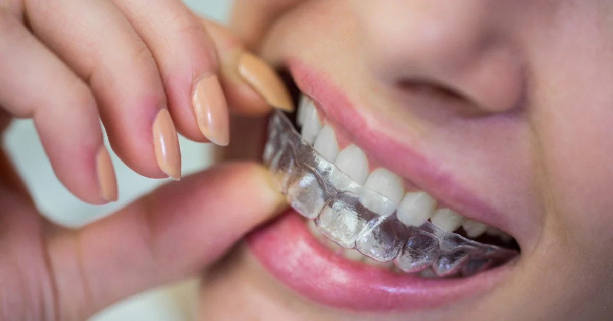 Orthodontics and Aligners