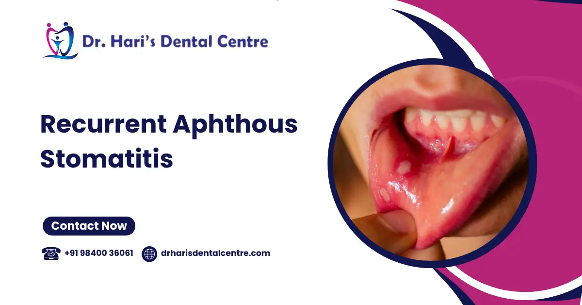 Recurrent Aphthous Stomatitis