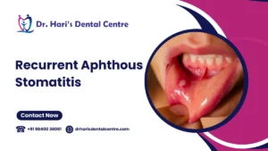 Recurrent Aphthous Stomatitis