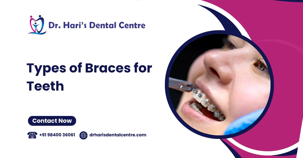 Types of Braces for Teeth