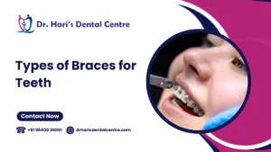 Types of Braces for Teeth