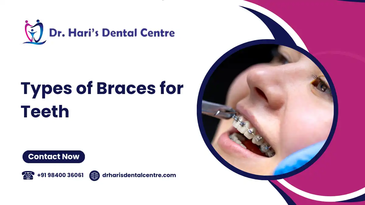 Types of Braces for Teeth