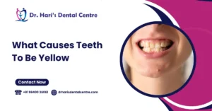 What Causes Teeth to Be Yellow? Top Reasons and How to Prevent Discoloration